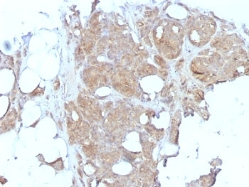 MVP / VAULT1 Antibody - Formalin-fixed, paraffin-embedded human breast carcinoma stained with Major Vault Protein antibody (1032).  This image was taken for the unmodified form of this product. Other forms have not been tested.