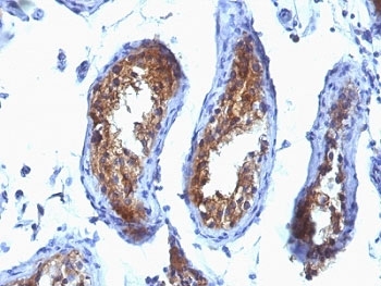 MVP / VAULT1 Antibody - Formalin-fixed, paraffin-embedded human testicular carcinoma stained with MVP antibody (SPM280).  This image was taken for the unmodified form of this product. Other forms have not been tested.