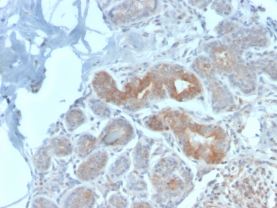 MVP / VAULT1 Antibody - Formalin-fixed, paraffin-embedded human Breast Carcinoma stained with Major Vault Protein Rabbit Recombinant Monoclonal Antibody (VP2897R).