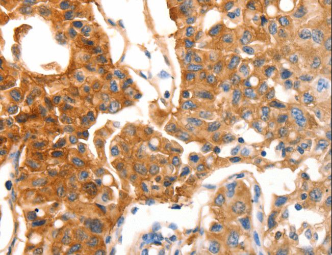 MVP / VAULT1 Antibody - Immunohistochemistry of paraffin-embedded Human lung cancer using MVP Polyclonal Antibody at dilution of 1:30.