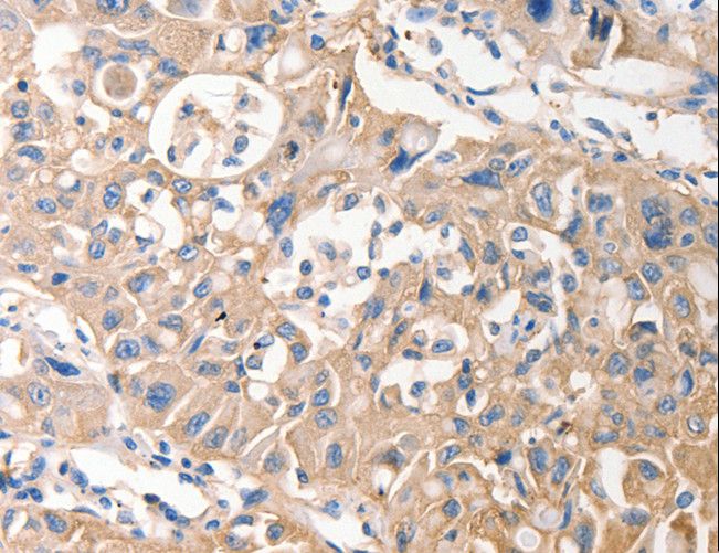 MVP / VAULT1 Antibody - Immunohistochemistry of paraffin-embedded Human lung cancer using MVP Polyclonal Antibody at dilution of 1:40.
