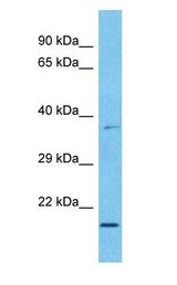 MXD3 / MAD3 Antibody - MXD3 / MAD3 antibody Western Blot of Esophagus Tumor. Antibody dilution: 1 ug/ml.  This image was taken for the unconjugated form of this product. Other forms have not been tested.