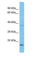 MXD3 / MAD3 Antibody - MXD3 / MAD3 antibody Western Blot of Esophagus Tumor. Antibody dilution: 1 ug/ml.  This image was taken for the unconjugated form of this product. Other forms have not been tested.