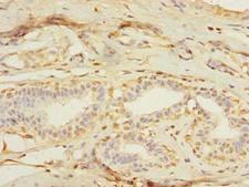 MXD3 / MAD3 Antibody - Immunohistochemistry of paraffin-embedded human breast cancer using antibody at dilution of 1:100.