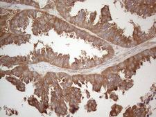 MXD4 Antibody - Immunohistochemical staining of paraffin-embedded Adenocarcinoma of Human ovary tissue using anti-MXD4 mouse monoclonal antibody. (Heat-induced epitope retrieval by 1mM EDTA in 10mM Tris buffer. (pH8.5) at 120°C for 3 min. (1:150)