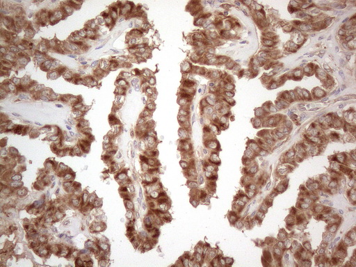 MXD4 Antibody - Immunohistochemical staining of paraffin-embedded Carcinoma of Human thyroid tissue using anti-MXD4 mouse monoclonal antibody. (Heat-induced epitope retrieval by 1mM EDTA in 10mM Tris buffer. (pH8.5) at 120°C for 3 min. (1:150)