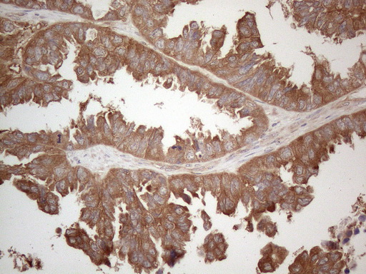 MXD4 Antibody - Immunohistochemical staining of paraffin-embedded Adenocarcinoma of Human ovary tissue using anti-MXD4 mouse monoclonal antibody. (Heat-induced epitope retrieval by 1mM EDTA in 10mM Tris buffer. (pH8.5) at 120°C for 3 min. (1:150)