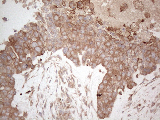 MXD4 Antibody - Immunohistochemical staining of paraffin-embedded Adenocarcinoma of Human endometrium tissue using anti-MXD4 mouse monoclonal antibody. (Heat-induced epitope retrieval by 1mM EDTA in 10mM Tris buffer. (pH8.5) at 120°C for 3 min. (1:150)