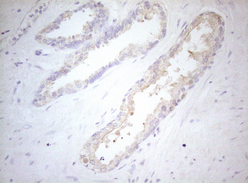 MXD4 Antibody - Immunohistochemical staining of paraffin-embedded Carcinoma of Human prostate tissue using anti-MXD4 mouse monoclonal antibody. (Heat-induced epitope retrieval by 1mM EDTA in 10mM Tris buffer. (pH8.5) at 120°C for 3 min. (1:150)
