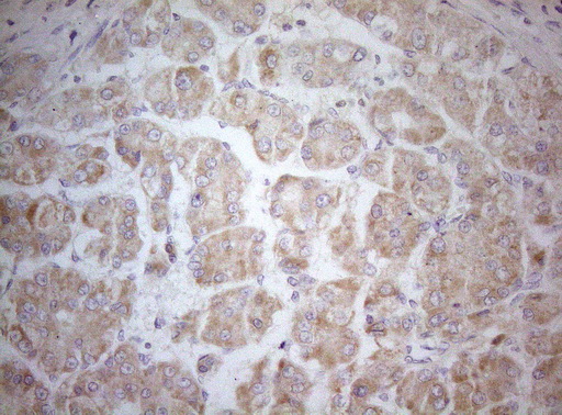 MXD4 Antibody - Immunohistochemical staining of paraffin-embedded Carcinoma of Human liver tissue using anti-MXD4 mouse monoclonal antibody. (Heat-induced epitope retrieval by 1mM EDTA in 10mM Tris buffer. (pH8.5) at 120°C for 3 min. (1:150)