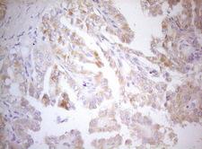 MXD4 Antibody - Immunohistochemical staining of paraffin-embedded Carcinoma of Human thyroid tissue using anti-MXD4 mouse monoclonal antibody. (Heat-induced epitope retrieval by 1mM EDTA in 10mM Tris buffer. (pH8.5) at 120°C for 3 min. (1:150)