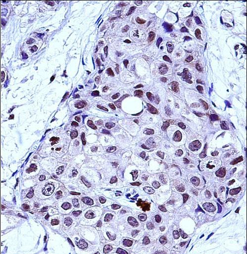 MYB / c-Myb Antibody - MYB Antibody immunohistochemistry of formalin-fixed and paraffin-embedded human breast carcinoma followed by peroxidase-conjugated secondary antibody and DAB staining.