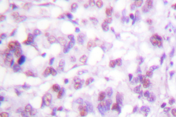 MYB / c-Myb Antibody - IHC of MYB (R6) pAb in paraffin-embedded human breast carcinoma tissue.