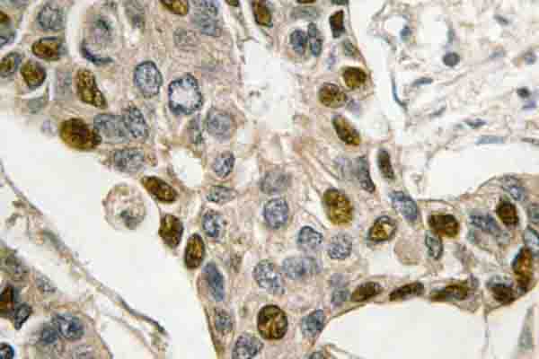 MYB / c-Myb Antibody - IHC of c-Myb (I526) pAb in paraffin-embedded human breast carcinoma tissue.