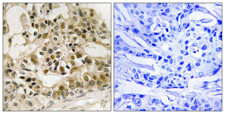 MYB / c-Myb Antibody - Immunohistochemistry analysis of paraffin-embedded human breast carcinoma, using Myb (Phospho-Ser532) Antibody. The picture on the right is blocked with the phospho peptide.