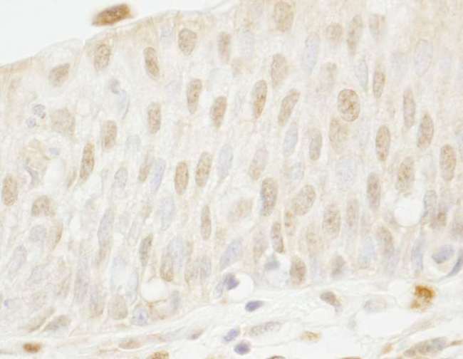 MYBBP1A Antibody - Detection of Human MYBBP1a by Immunohistochemistry. Sample: FFPE section of human bladder cell carcinoma. Antibody: Affinity purified rabbit anti-MYBBP1a used at a dilution of 1:250.