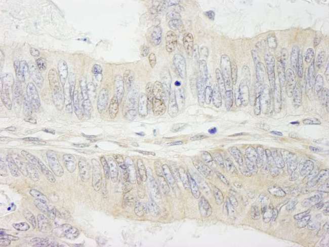 MYBBP1A Antibody - Detection of Human MYBBP1a by Immunohistochemistry. Sample: FFPE section of human colon carcinoma. Antibody: Affinity purified rabbit anti-MYBBP1a used at a dilution of 1:250.