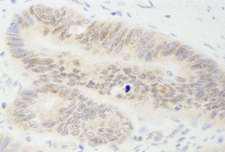 MYBBP1A Antibody - Detection of Human MYBBP1a by Immunohistochemistry. Sample: FFPE section of human colon carcinoma. Antibody: Affinity purified rabbit anti-MYBBP1a used at a dilution of 1:1000 (1 ug/ml). Detection: DAB.