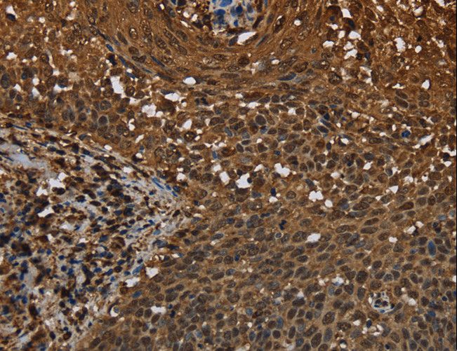 MYBBP1A Antibody - Immunohistochemistry of paraffin-embedded Human colon cancer using MYBBP1A Polyclonal Antibody at dilution of 1:40.