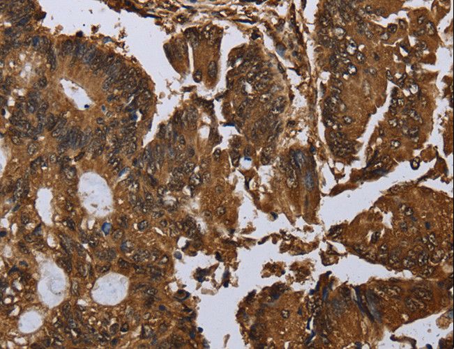 MYBBP1A Antibody - Immunohistochemistry of paraffin-embedded Human colon cancer using MYBBP1A Polyclonal Antibody at dilution of 1:40.