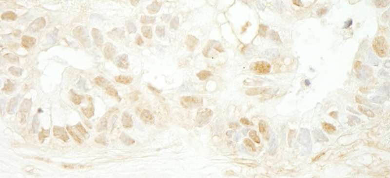 MYBL2 Antibody - Detection of Human B-Myb by Immunohistochemistry. Sample: FFPE section of human breast carcinoma. Antibody: Affinity purified rabbit anti-B-Myb used at a dilution of 1:1000 (1 ug/ml).