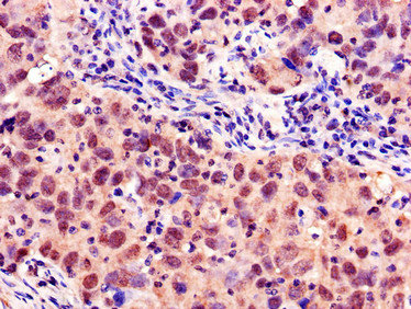 MYBL2 Antibody - Immunohistochemistry of paraffin-embedded human pancreatic cancer using MYBL2 Antibody at dilution of 1:100