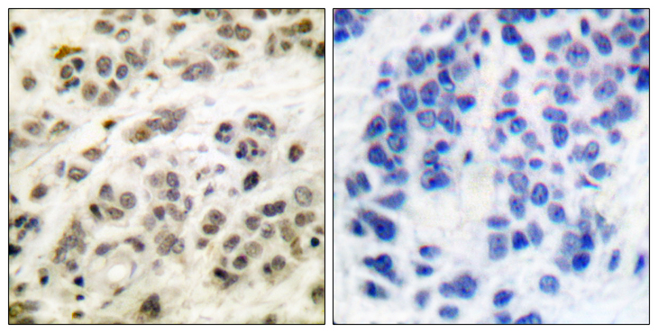 MYC / c-Myc Antibody - Immunohistochemistry analysis of paraffin-embedded human breast carcinoma tissue, using MYC Antibody. The picture on the right is blocked with the synthesized peptide.