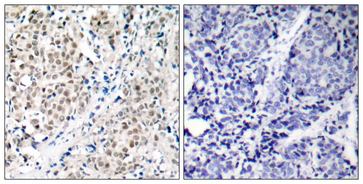 MYC / c-Myc Antibody - Immunohistochemistry analysis of paraffin-embedded human breast carcinoma tissue, using MYC Antibody. The picture on the right is blocked with the synthesized peptide.