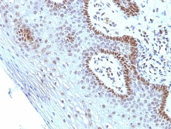 MYC / c-Myc Antibody - Formalin-fixed, paraffin-embedded human cervical carcinoma stained with Myc antibody (SPM237).  This image was taken for the unmodified form of this product. Other forms have not been tested.