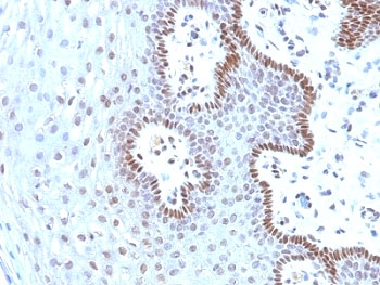 MYC / c-Myc Antibody - Formalin-fixed, paraffin-embedded human cervical carcinoma stained with c-Myc antibody (9E10.3).  This image was taken for the unmodified form of this product. Other forms have not been tested.
