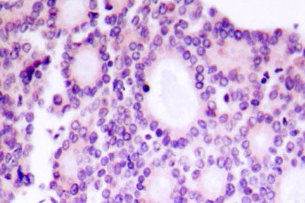 MYC / c-Myc Antibody - IHC of Myc (R367) pAb in paraffin-embedded human breast carcinoma tissue.