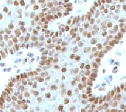 MYC / c-Myc Antibody - IHC testing of FFPE human cervical carcinoma and c-Myc antibody (MVH39-1).  This image was taken for the unmodified form of this product. Other forms have not been tested.
