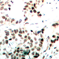 MYC / c-Myc Antibody - Immunohistochemical analysis of c-Myc (pT358) staining in human breast cancer formalin fixed paraffin embedded tissue section. The section was pre-treated using heat mediated antigen retrieval with sodium citrate buffer (pH 6.0). The section was then incubated with the antibody at room temperature and detected using an HRP conjugated compact polymer system. DAB was used as the chromogen. The section was then counterstained with hematoxylin and mounted with DPX.