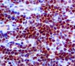 MYC / c-Myc Antibody - IHC of c-Myc on FFPE Burkittâ€™s Lymphoma tissue.