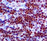 MYC / c-Myc Antibody - IHC of c-Myc on FFPE Burkitt's Lymphoma tissue. This image was taken for the unmodified form of this product. Other forms have not been tested.