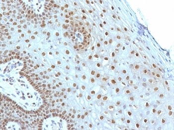 MYC / c-Myc Antibody - Formalin-fixed, paraffin-embedded human cervical carcinoma stained with c-Myc antibody (MYC275).  This image was taken for the unmodified form of this product. Other forms have not been tested.