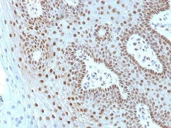 MYC / c-Myc Antibody - Formalin-fixed, paraffin-embedded human cervical carcinoma stained with c-Myc antibody (MYC275 + MYC909).  This image was taken for the unmodified form of this product. Other forms have not been tested.