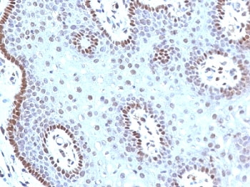 MYC / c-Myc Antibody - Formalin-fixed, paraffin-embedded human cervical carcinoma stained with c-Myc antibody (MYC909).  This image was taken for the unmodified form of this product. Other forms have not been tested.