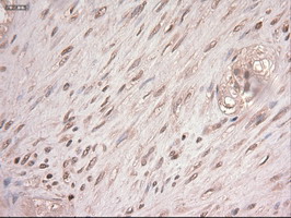 MYC / c-Myc Antibody - IHC of paraffin-embedded Carcinoma of Human pancreas tissue using anti-MYC mouse monoclonal antibody.