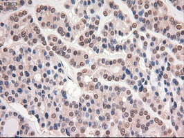 MYC / c-Myc Antibody - IHC of paraffin-embedded Carcinoma of Human thyroid tissue using anti-MYC mouse monoclonal antibody.