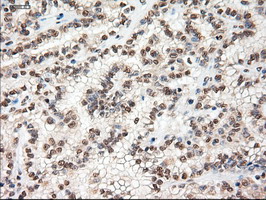 MYC / c-Myc Antibody - IHC of paraffin-embedded Carcinoma of Human kidney tissue using anti-MYC mouse monoclonal antibody.