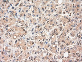 MYC / c-Myc Antibody - IHC of paraffin-embedded Carcinoma of Human liver tissue using anti-MYC mouse monoclonal antibody.