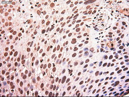 MYC / c-Myc Antibody - IHC of paraffin-embedded Carcinoma of Human lung tissue using anti-MYC mouse monoclonal antibody.