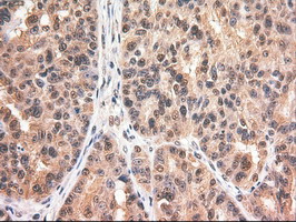 MYC / c-Myc Antibody - IHC of paraffin-embedded Adenocarcinoma of Human ovary tissue using anti-MYC mouse monoclonal antibody.