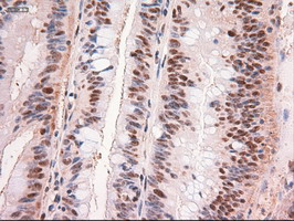 MYC / c-Myc Antibody - IHC of paraffin-embedded Adenocarcinoma of Human colon tissue using anti-MYC mouse monoclonal antibody.