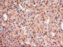 MYC / c-Myc Antibody - IHC of paraffin-embedded Adenocarcinoma of Human ovary tissue using anti-MYC mouse monoclonal antibody.