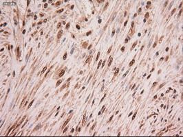MYC / c-Myc Antibody - IHC of paraffin-embedded Carcinoma of Human pancreas tissue using anti-MYC mouse monoclonal antibody.