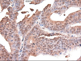 MYC / c-Myc Antibody - IHC of paraffin-embedded Adenocarcinoma of Human endometrium tissue using anti-MYC mouse monoclonal antibody.