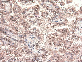 MYC / c-Myc Antibody - IHC of paraffin-embedded Carcinoma of Human kidney tissue using anti-MYC mouse monoclonal antibody.