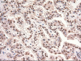 MYC / c-Myc Antibody - IHC of paraffin-embedded Carcinoma of Human kidney tissue using anti-MYC mouse monoclonal antibody.